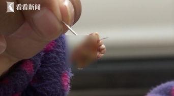 拔牙髓视频,直观视频带你了解牙髓拔除全流程